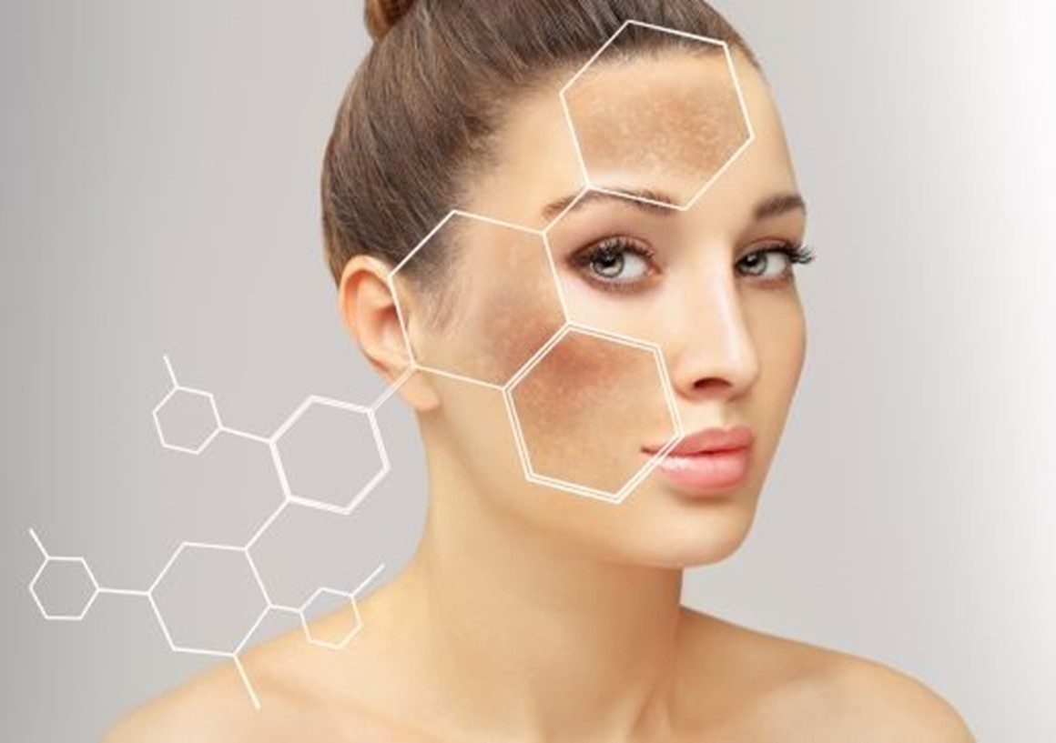 Šta je "Hiperpigmentacija" i kako je prepoznati?